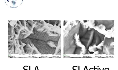 آماده سازی سطح ایمپلنت به روش SLActive